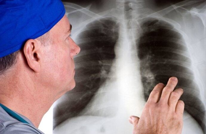 “Her Yıl 1.8 Milyon İnsan Akciğer Kanserinden Ölüyor”