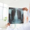 Akciğer Naklinde Nelere Dikkat Edilmeli?